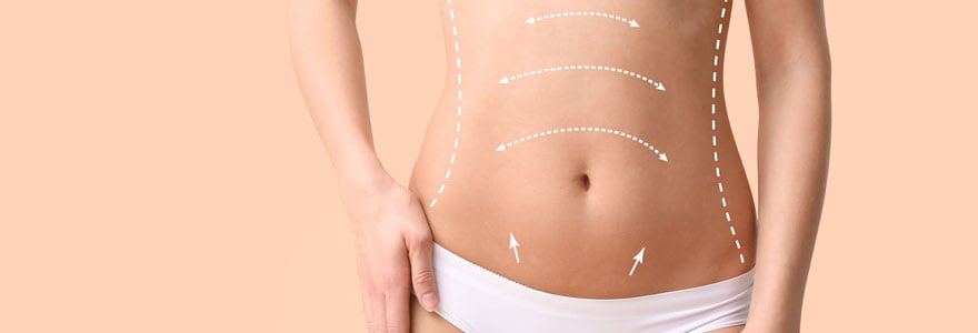 abdominoplastie